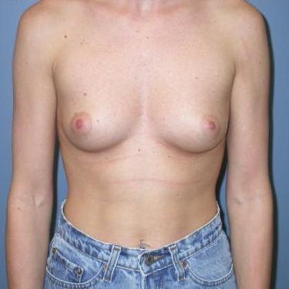 Before Image: Breast Augmentation: Case 1 - front