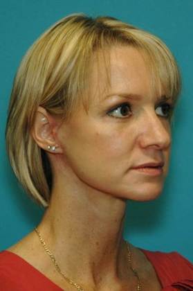 After Image: Mini Facelift: Case 1 - right-front-oblique