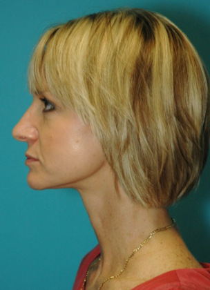 After Image: Mini Facelift: Case 1 - left-side