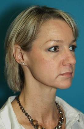 Before Image: Mini Facelift: Case 1 - right-front-oblique