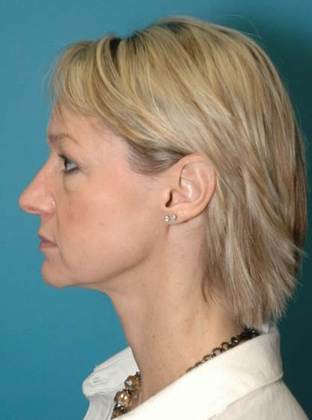 Before Image: Mini Facelift: Case 1 - left-side
