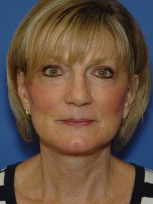 After Image: Face & Neck Lifts: Case 1