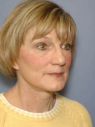 After Image: Face & Neck Lifts: Case 1 - right-front-oblique