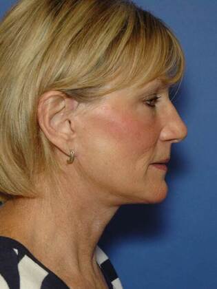 After Image: Face & Neck Lifts: Case 1 - right-side