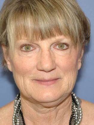 Before Image: Face & Neck Lifts: Case 1