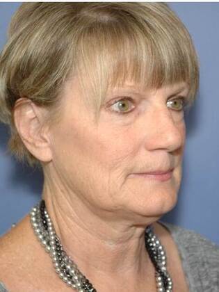 Before Image: Face & Neck Lifts: Case 1 - right-front-oblique