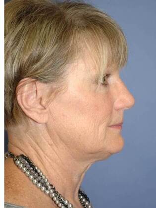 Before Image: Face & Neck Lifts: Case 1 - right-side