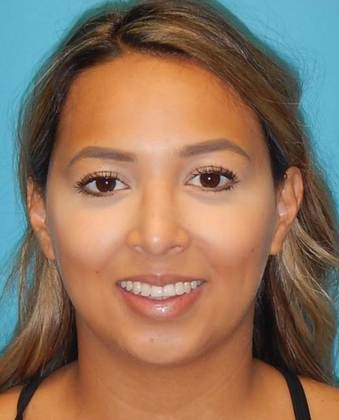 After Image: Rhinoplasty: Case 1 - front