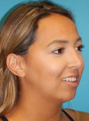 After Image: Rhinoplasty: Case 1 - right-front-oblique
