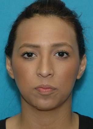 Before Image: Rhinoplasty: Case 1 - front