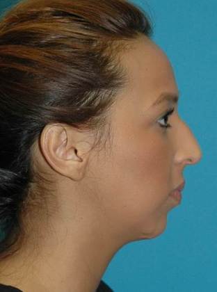 Before Image: Rhinoplasty: Case 1 - right-side