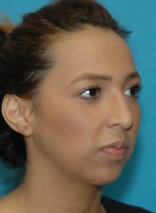 Before Image: Rhinoplasty: Case 1 - right-front-oblique