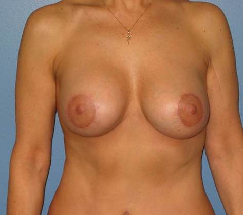 After Image: Breast Lift Augmentation: Case 1 - front
