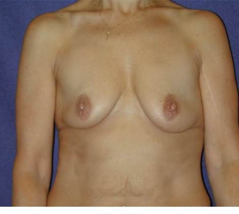 Before Image: Breast Lift Augmentation: Case 1 - front