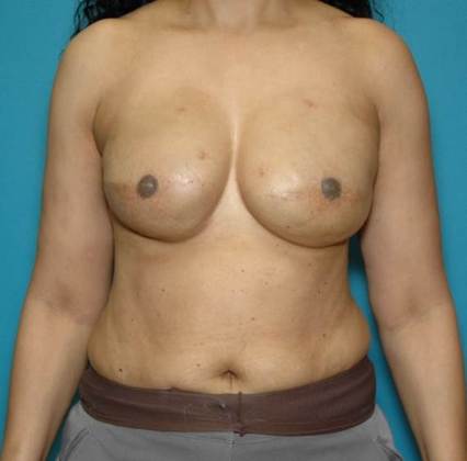 After Image: Breast Reconstruction: Case 1 - front