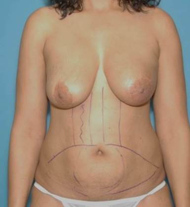 Before Image: Breast Reconstruction: Case 1 - front