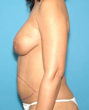 Before Image: Breast Reconstruction: Case 1 - left-side
