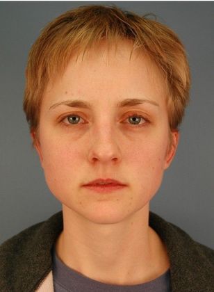 After Image: Otoplasty: Case 1 - front