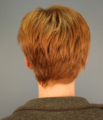 After Image: Otoplasty: Case 1 - back