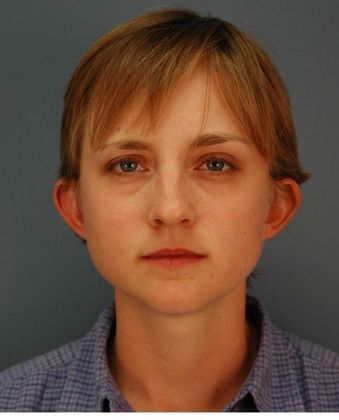 Before Image: Otoplasty: Case 1 - front