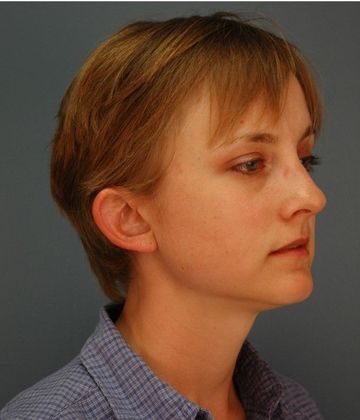 Before Image: Otoplasty: Case 1 - right-front-oblique