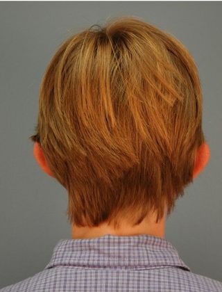 Before Image: Otoplasty: Case 1 - back