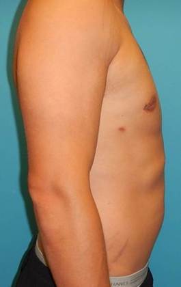 After Image: Gynecomastia: Case 1 - right-side