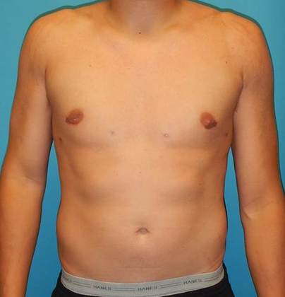 After Image: Gynecomastia: Case 1 - front