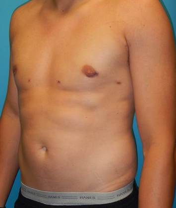 After Image: Gynecomastia: Case 1 - left-front-oblique
