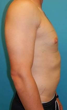 Before Image: Gynecomastia: Case 1 - right-side