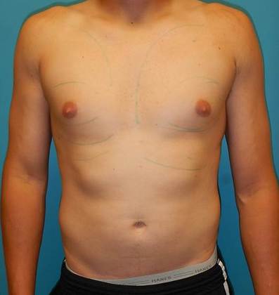 Before Image: Gynecomastia: Case 1 - front
