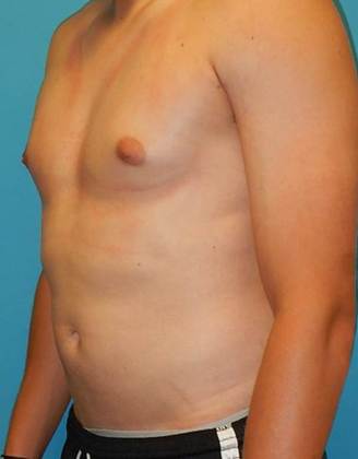Before Image: Gynecomastia: Case 1 - left-front-oblique