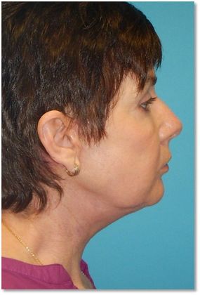 After Image: Neck Lift: Case 1 - right-side