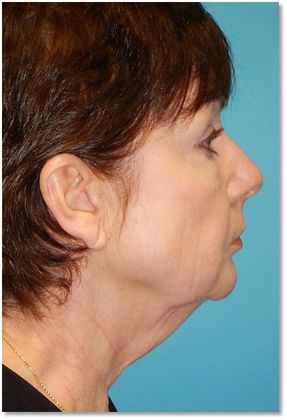 Before Image: Neck Lift: Case 1 - right-side
