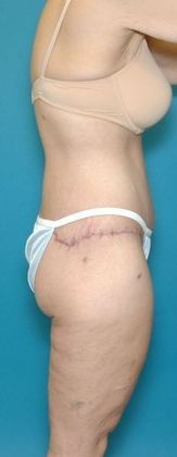 After Image: Body Lifts: Case 1 - right-side