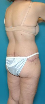After Image: Body Lifts: Case 1 - right-back-oblique