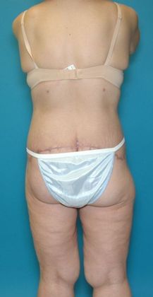 After Image: Body Lifts: Case 1 - back
