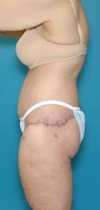 After Image: Body Lifts: Case 1 - left-side
