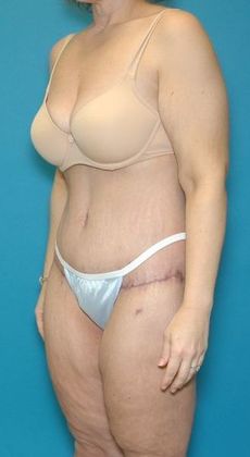 After Image: Body Lifts: Case 1 - left-front-oblique