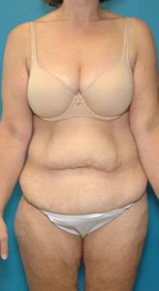 Before Image: Body Lifts: Case 1 - front