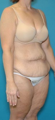 Before Image: Body Lifts: Case 1 - right-front-oblique
