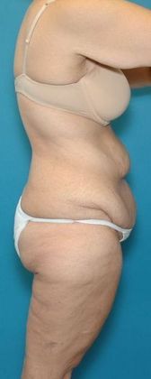 Before Image: Body Lifts: Case 1 - right-side