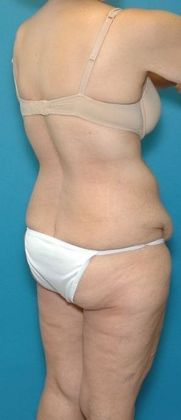 Before Image: Body Lifts: Case 1 - right-back-oblique