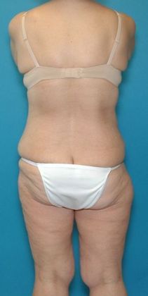 Before Image: Body Lifts: Case 1 - back