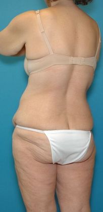 Before Image: Body Lifts: Case 1 - left-back-oblique