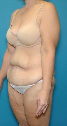 Before Image: Body Lifts: Case 1 - left-front-oblique