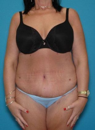 After Image: Arm Lift: Case 1 - front