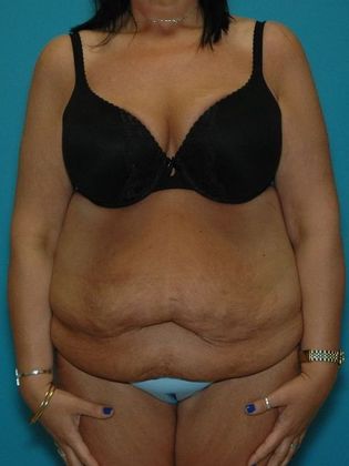 Before Image: Arm Lift: Case 1 - front