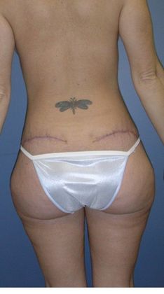 After Image: Mommy Makeover: Case 1 - back