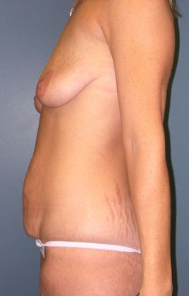 Before Image: Mommy Makeover: Case 1 - left-side